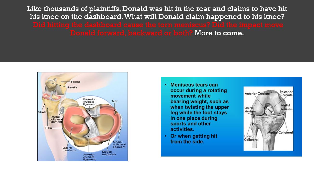 Did hitting the dashboard cause the torn meniscus? Did the impact move Donald forward, backward or both?